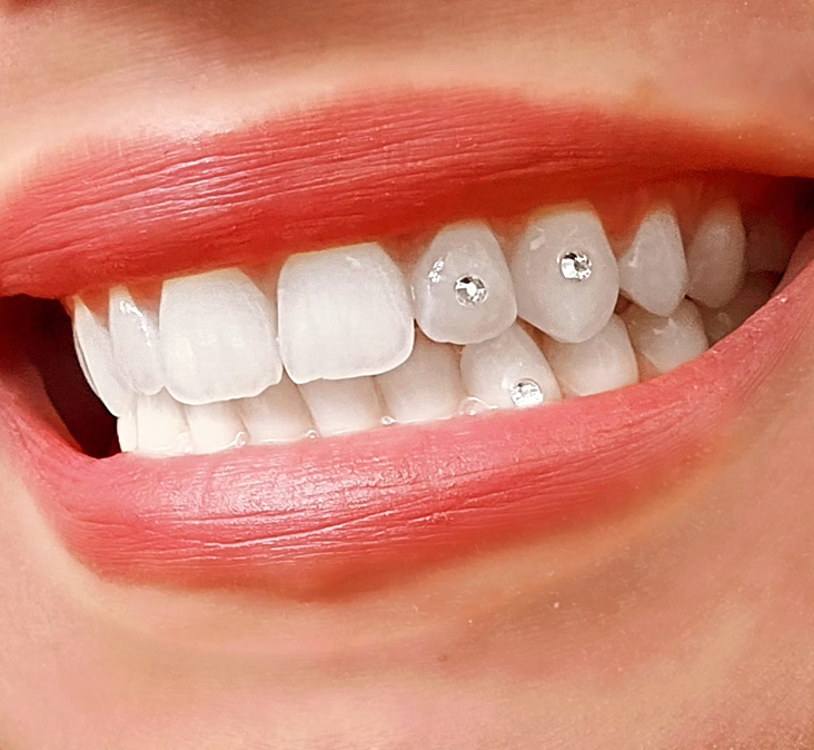 Orthodontic Treatment