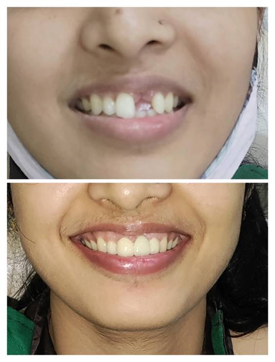 Orthodontic Treatment