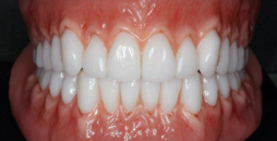 Orthodontic Treatment