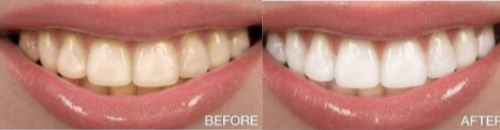 Orthodontic Treatment