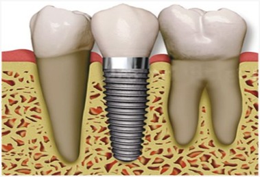Orthodontic Treatment