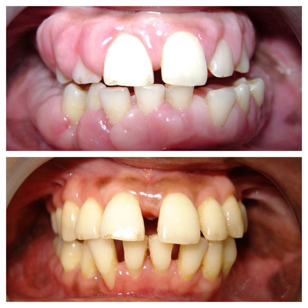 Gum Surgery Image