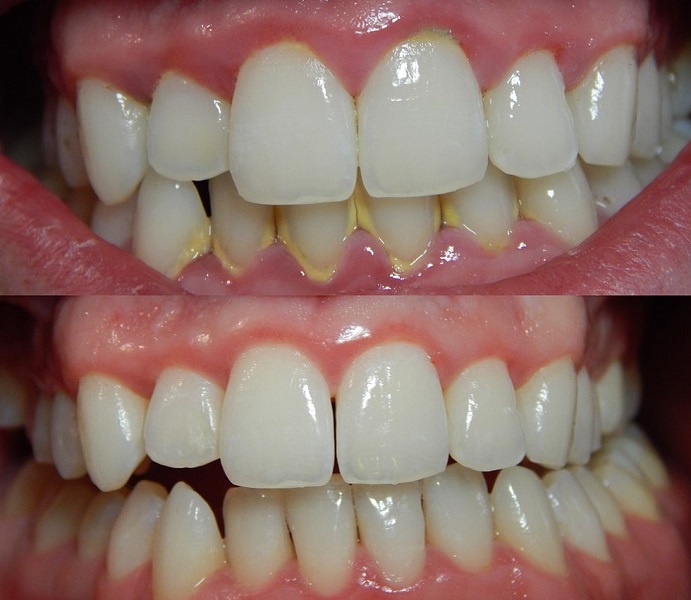 Orthodontic Treatment