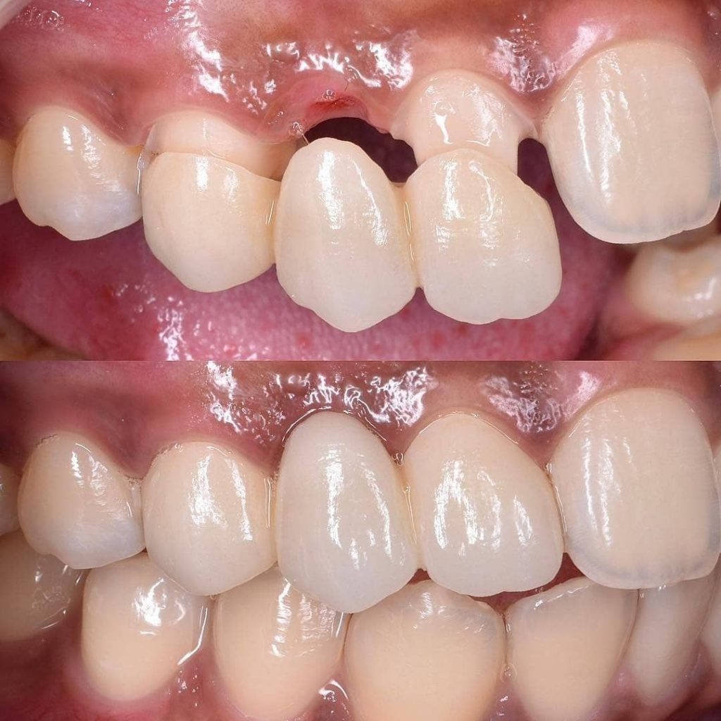 Orthodontic Treatment