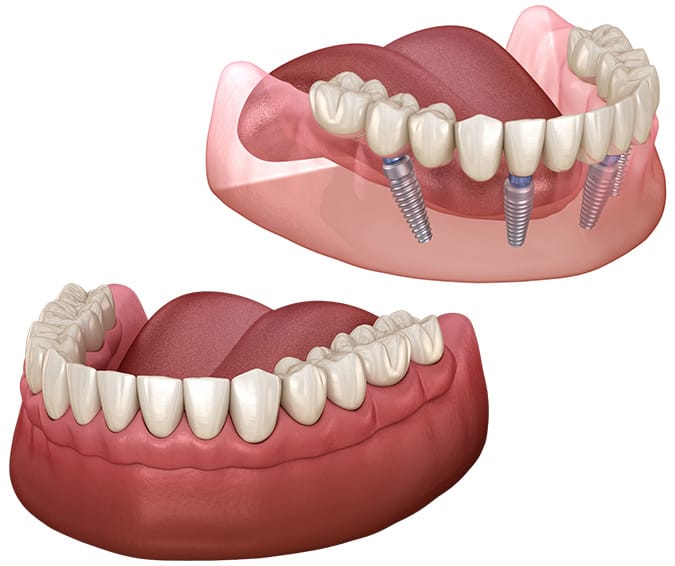 Orthodontic Treatment