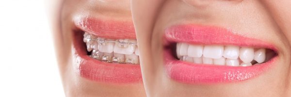 Orthodontic Treatment