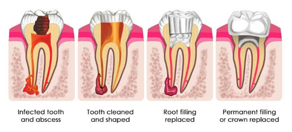 Orthodontic Treatment