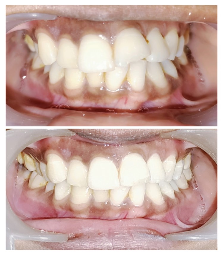 Orthodontic Treatment