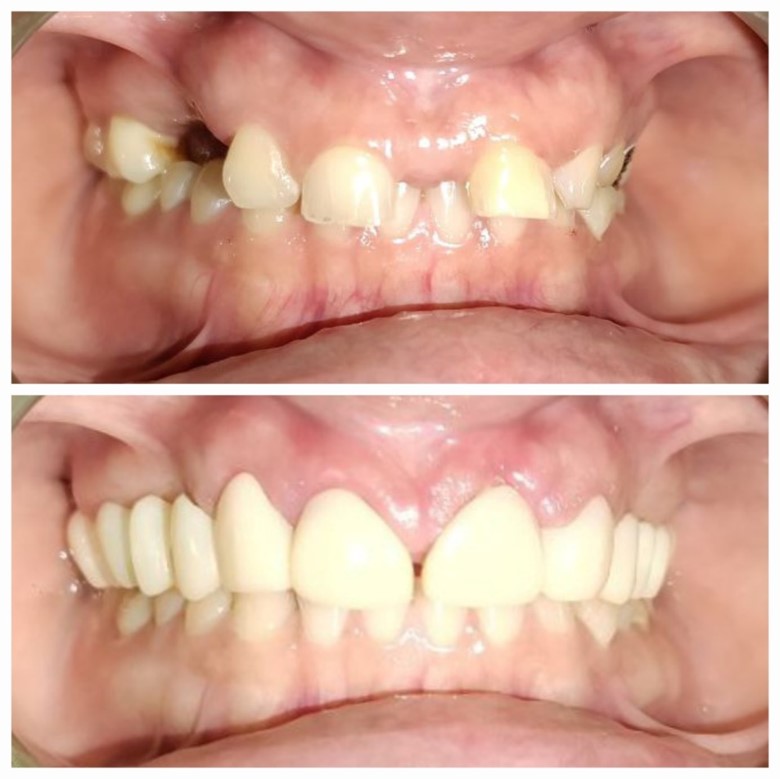 Orthodontic Treatment